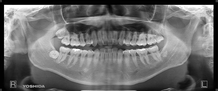 歯周病と全身疾患との関わり